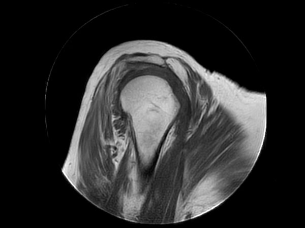 Sagittal MultiVane XD - T1w TSE