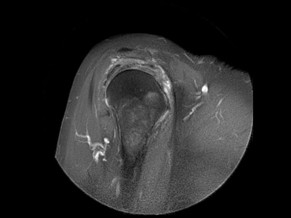 Sagittal MultiVane XD - PDw SPAIR