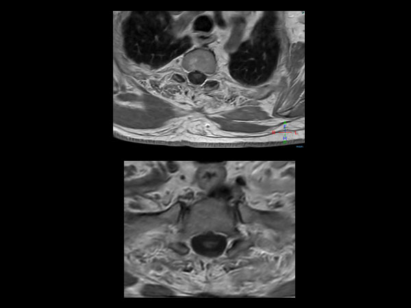 Axial T1w SE (post-gado)