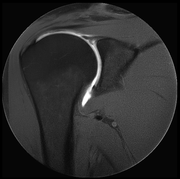Coronal MultiVane XD - T1w SPAIR 