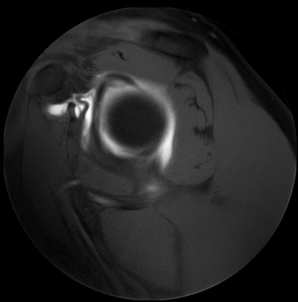 Sagittal MultiVane XD - T1w SPAIR