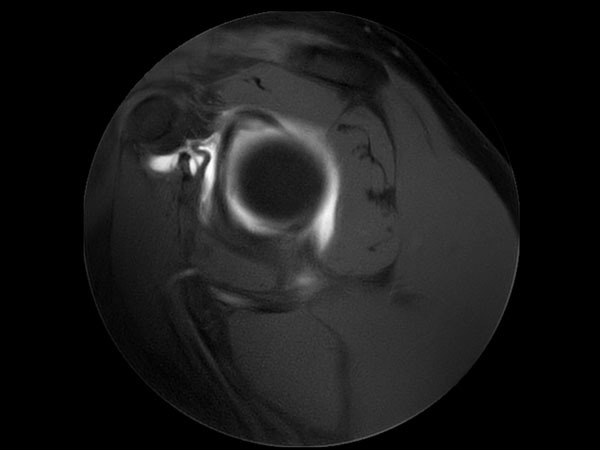 Sagittal MultiVane XD - T1w SPAIR