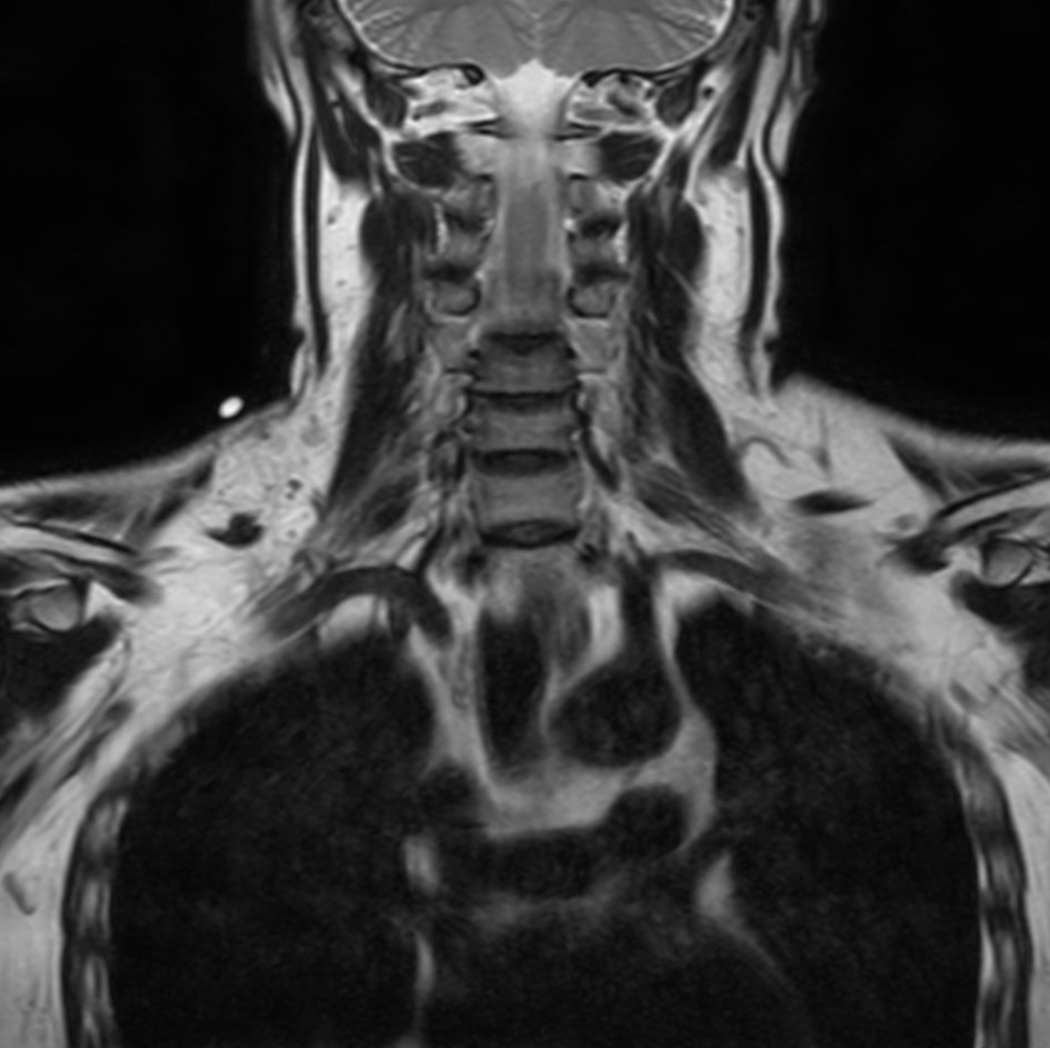 Coronal T2w mDIXON XD TSE (In Phase)