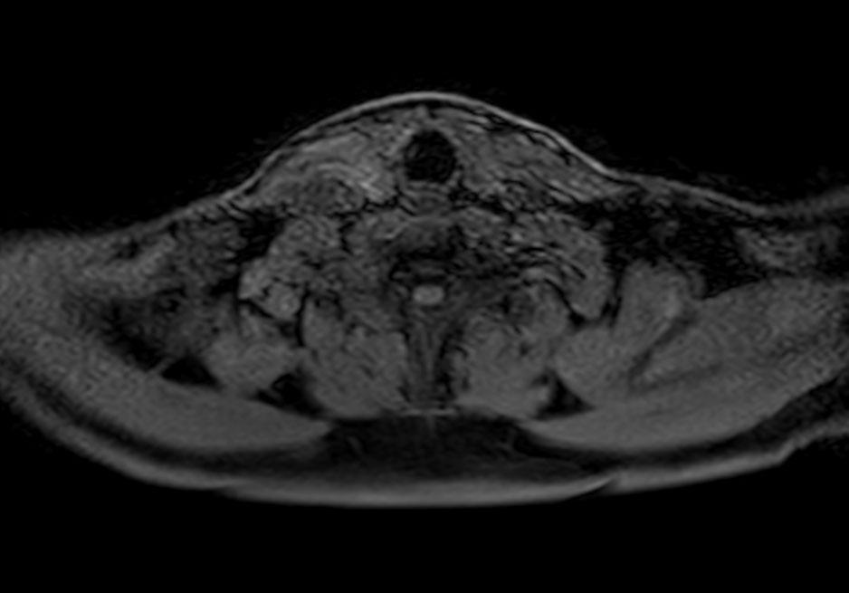 Axial T1w mDIXON XD FFE (blanco)