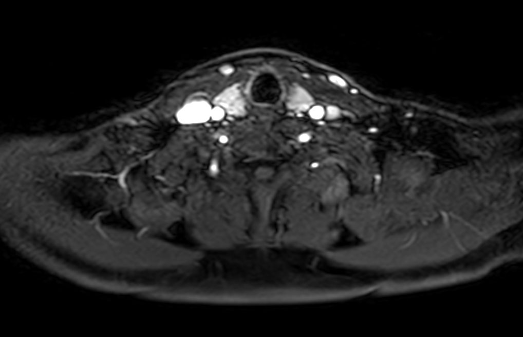 Axial T1w mDIXON XD FFE (1st dynamic)