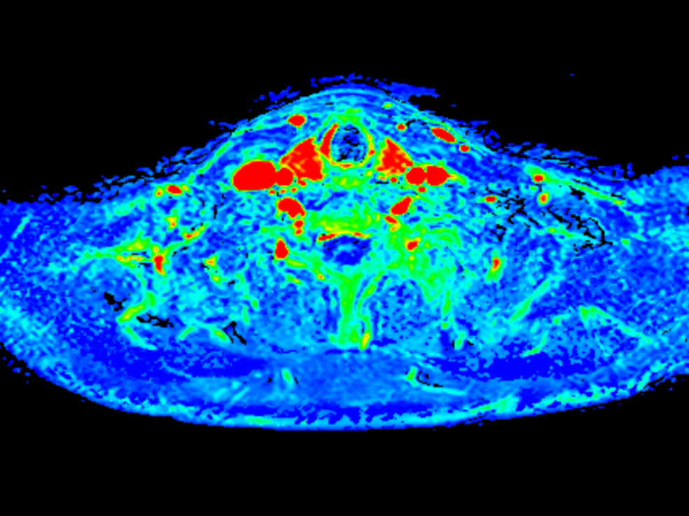 Axial T1w mDIXON XD FFE (area under the curve)