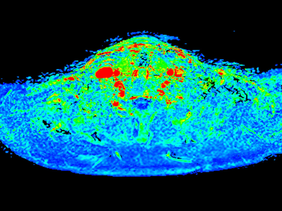 Axial T1w mDIXON XD FFE (wash-in)
