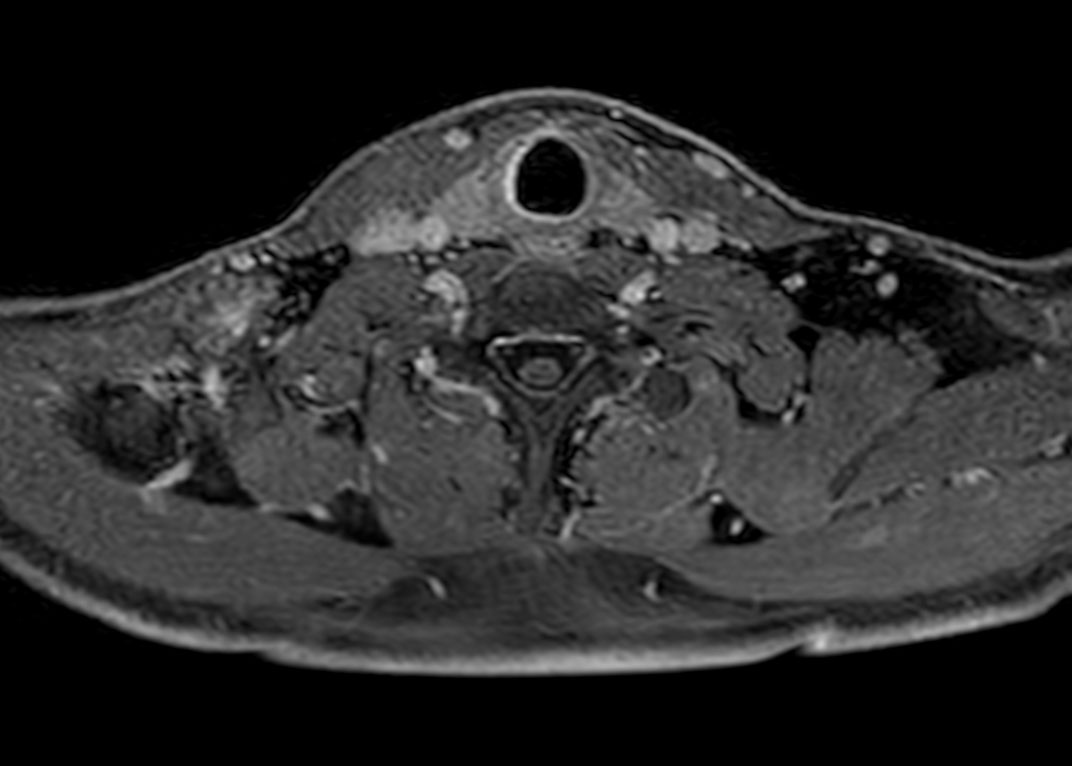 Axial T1w mDIXON XD FFE (high res)