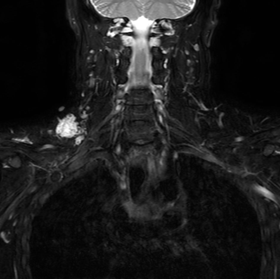 Coronal T2w mDIXON XD TSE (Water only)