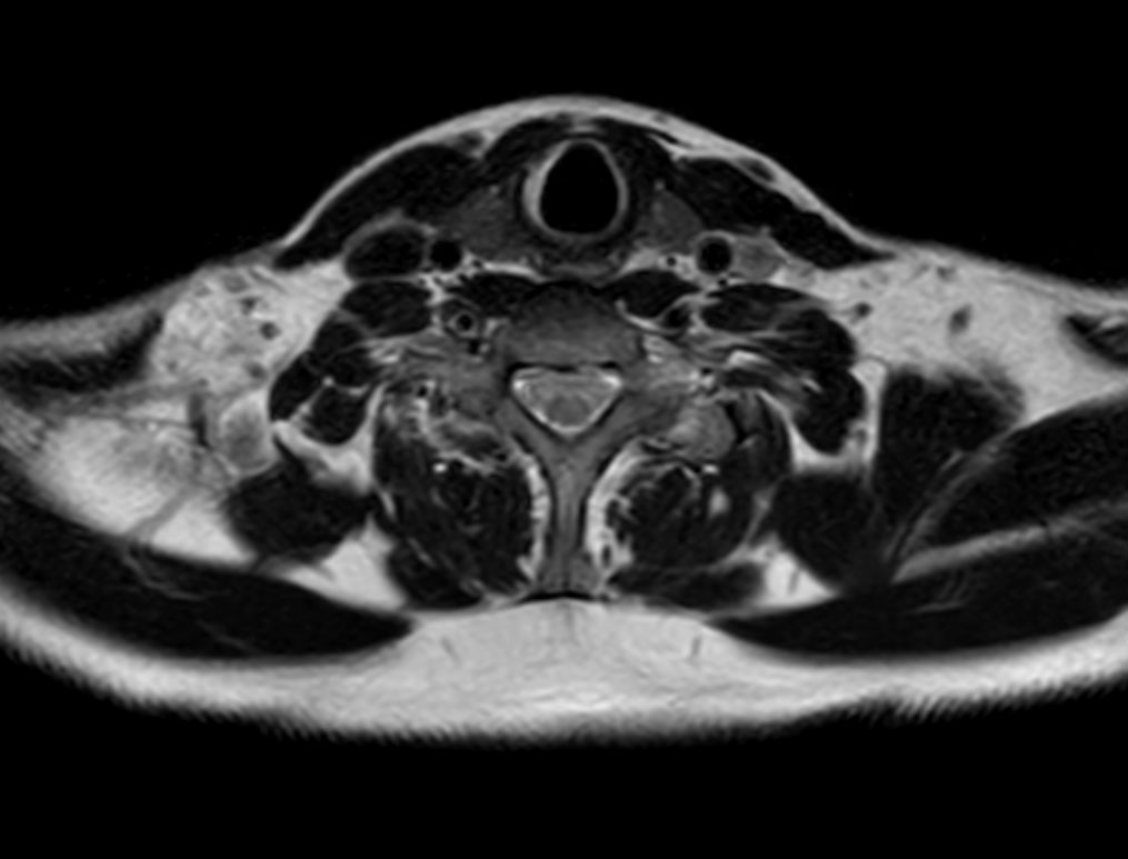 Axial T2w mDIXON XD TSE (In Phase)