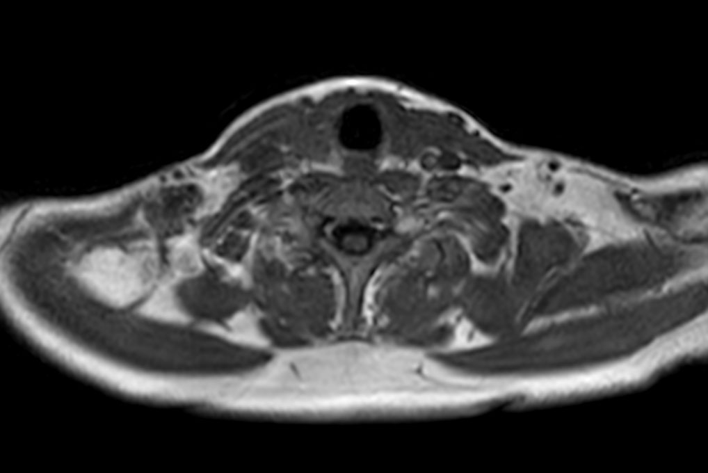 Axial T1w mDIXON XD FFE (In Phase)
