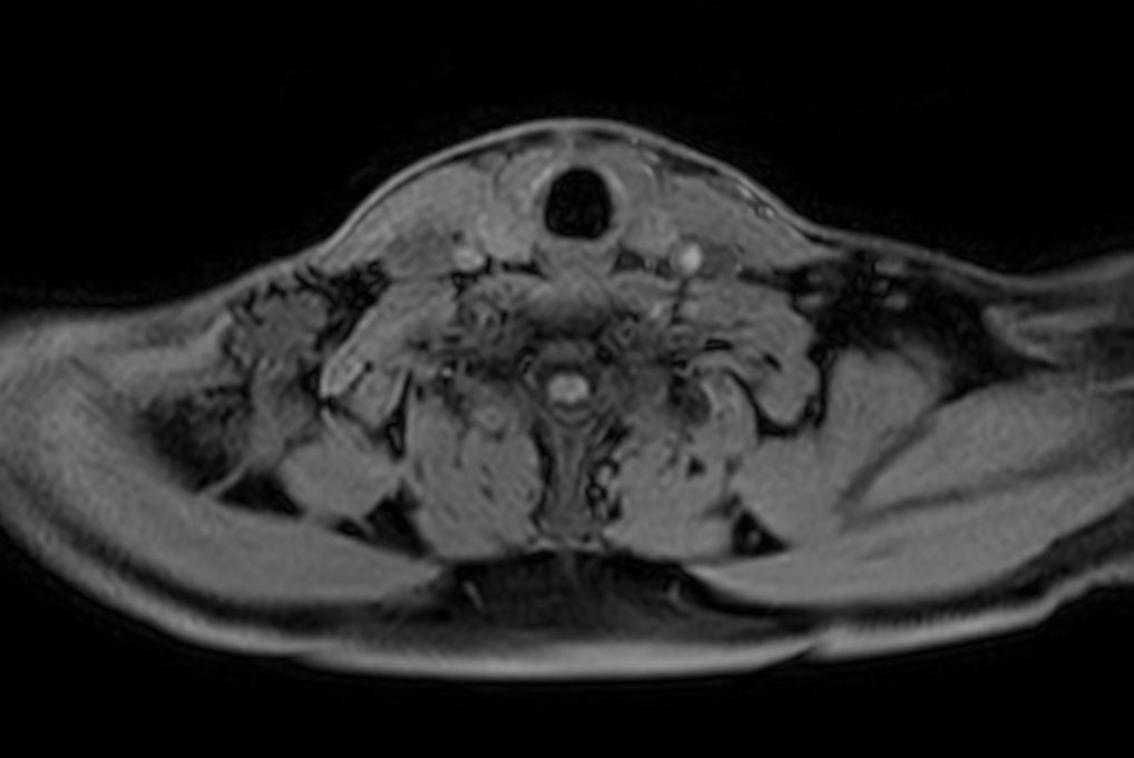 Axial T1w mDIXON XD FFE (Water only)