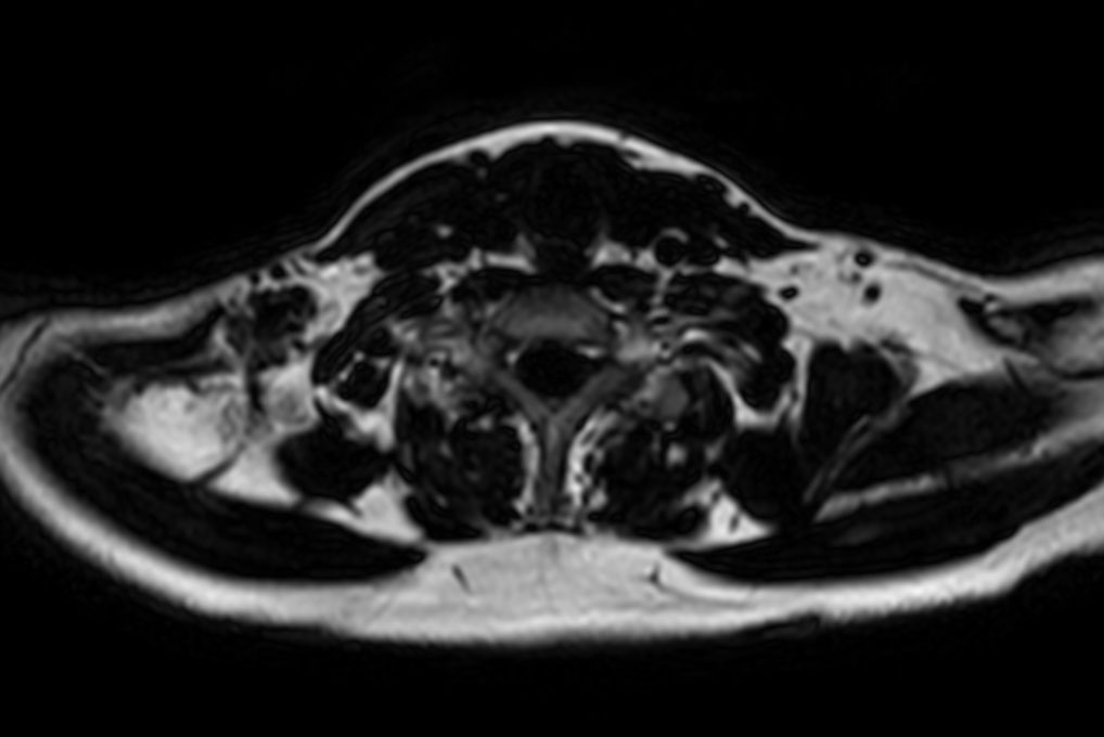 Axial T1w mDIXON XD FFE (Fat only)