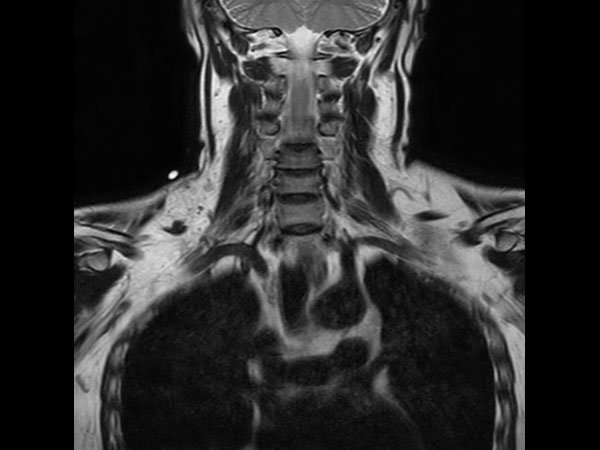 Coronal T2w mDIXON XD TSE (In Phase)