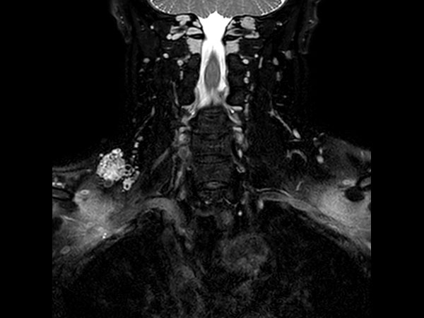 Coronal T2w VISTA