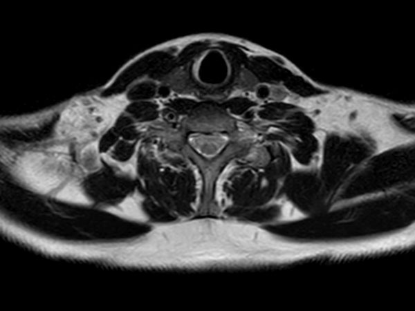 Axial T2w mDIXON XD TSE (In Phase)