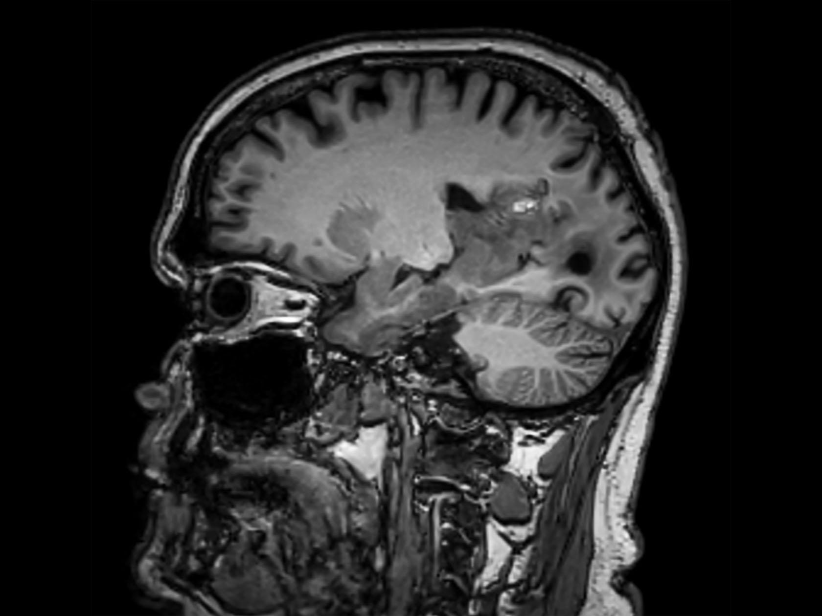 Sagittal 3D T1w TFE