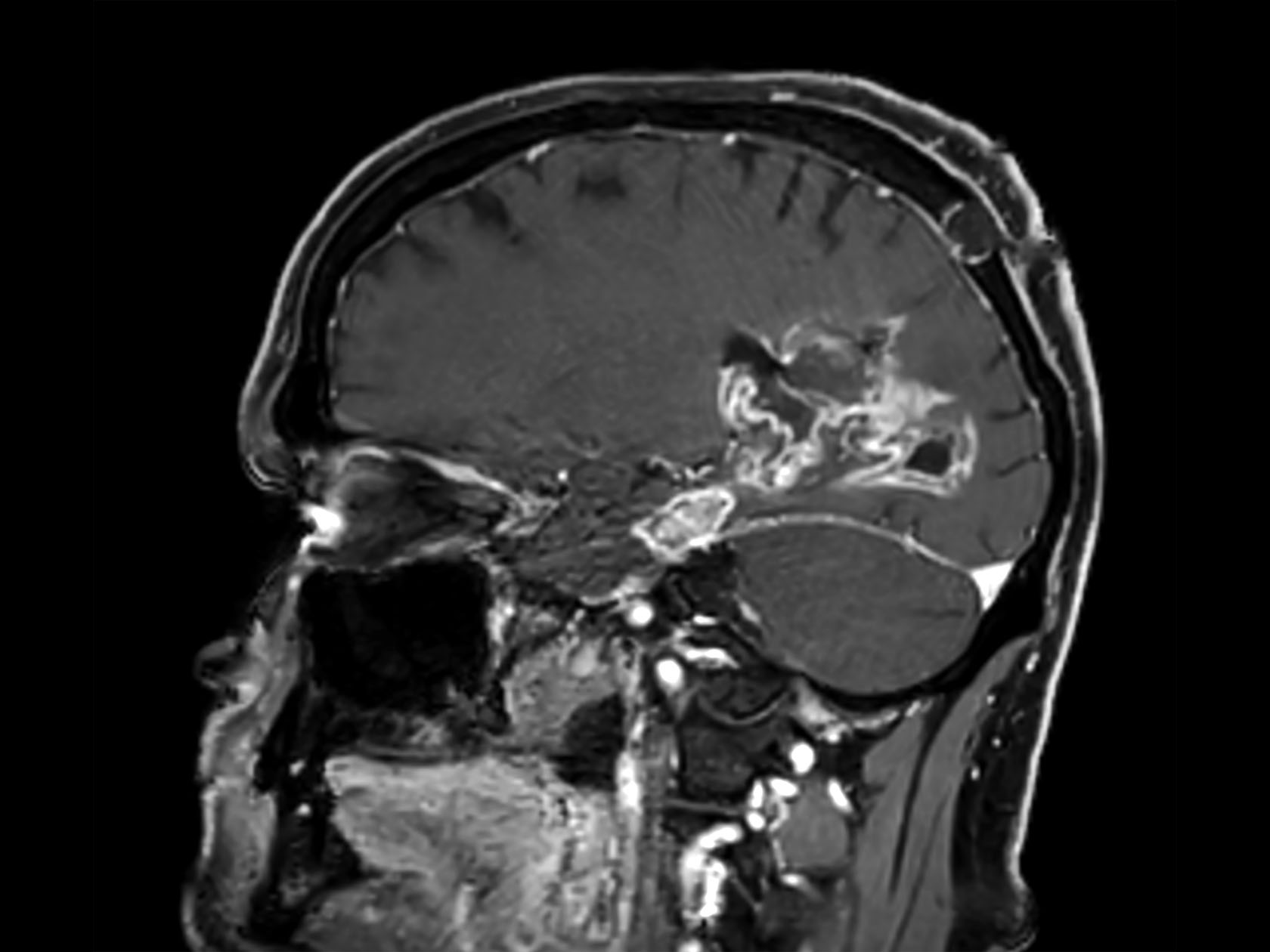 Sagittal 3D T1w FFE mDIXON (post-gado)