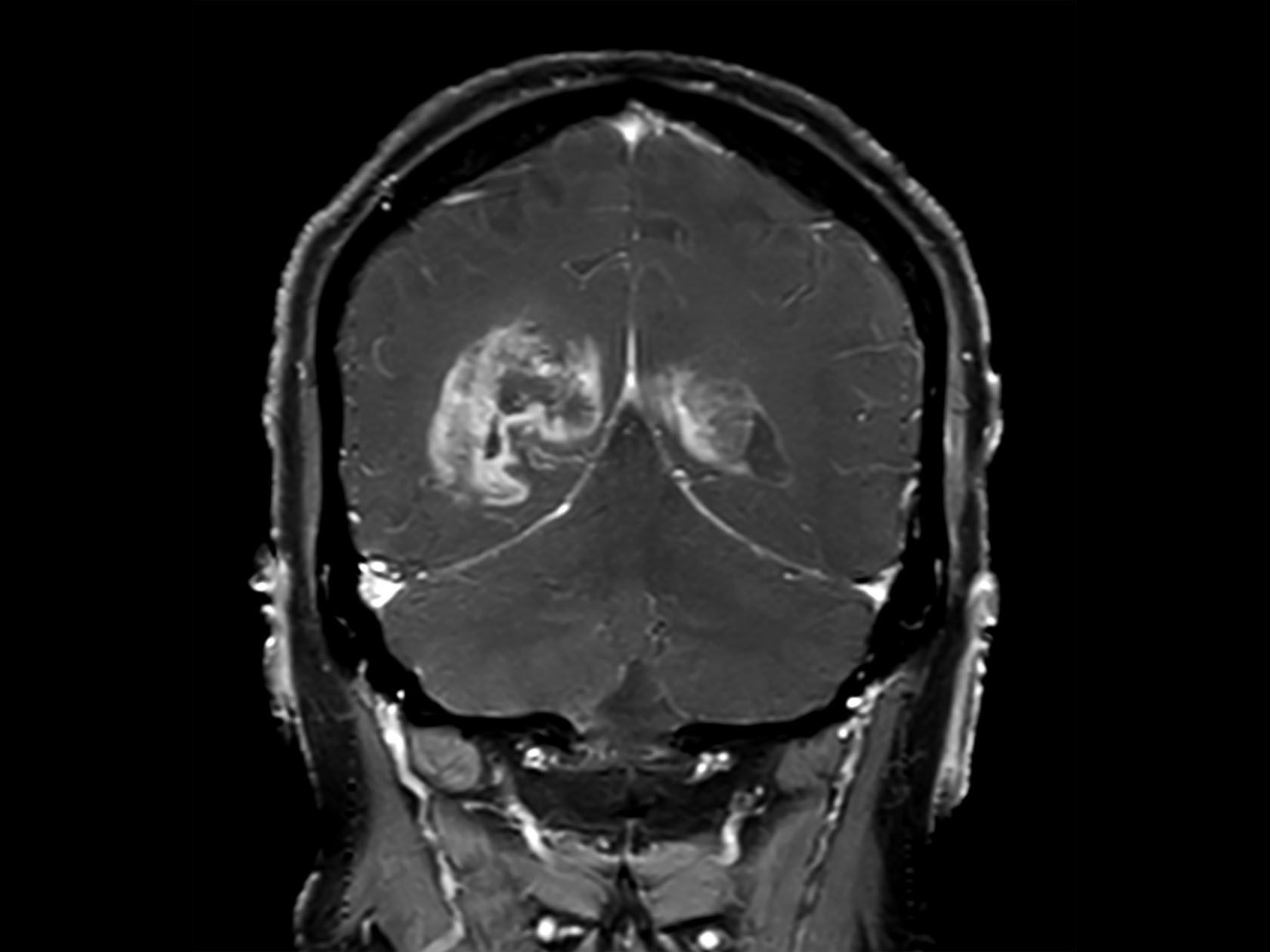 Coronal T1w FFE (post-gado)