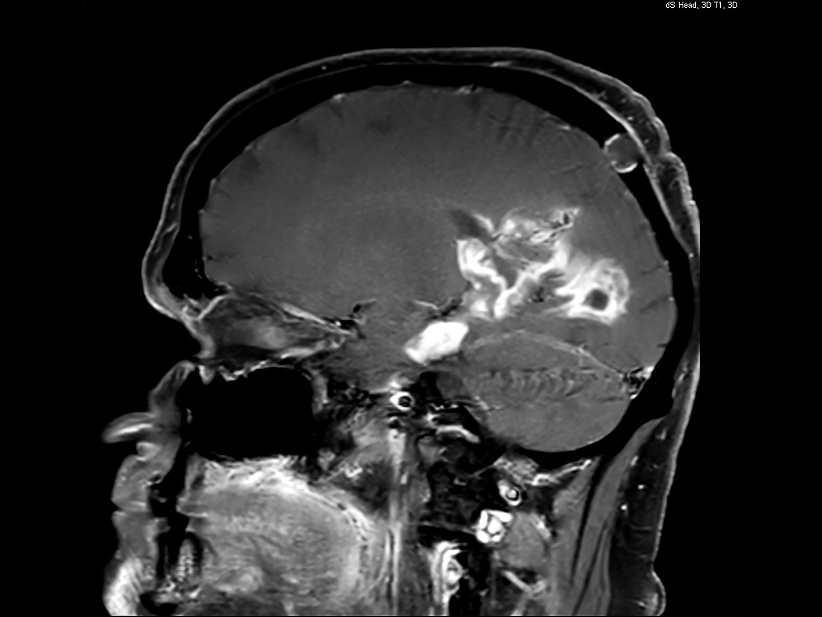 Sagittal T1w FFE (post-gado)