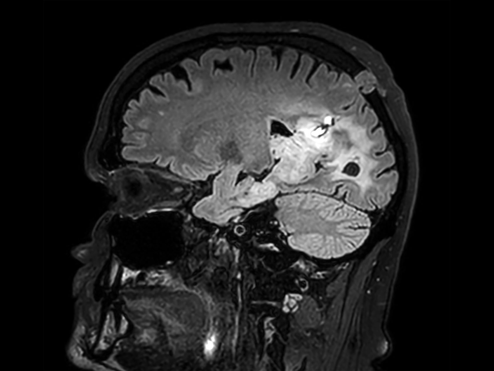 Sagittal 3D BrainVIEW FLAIR