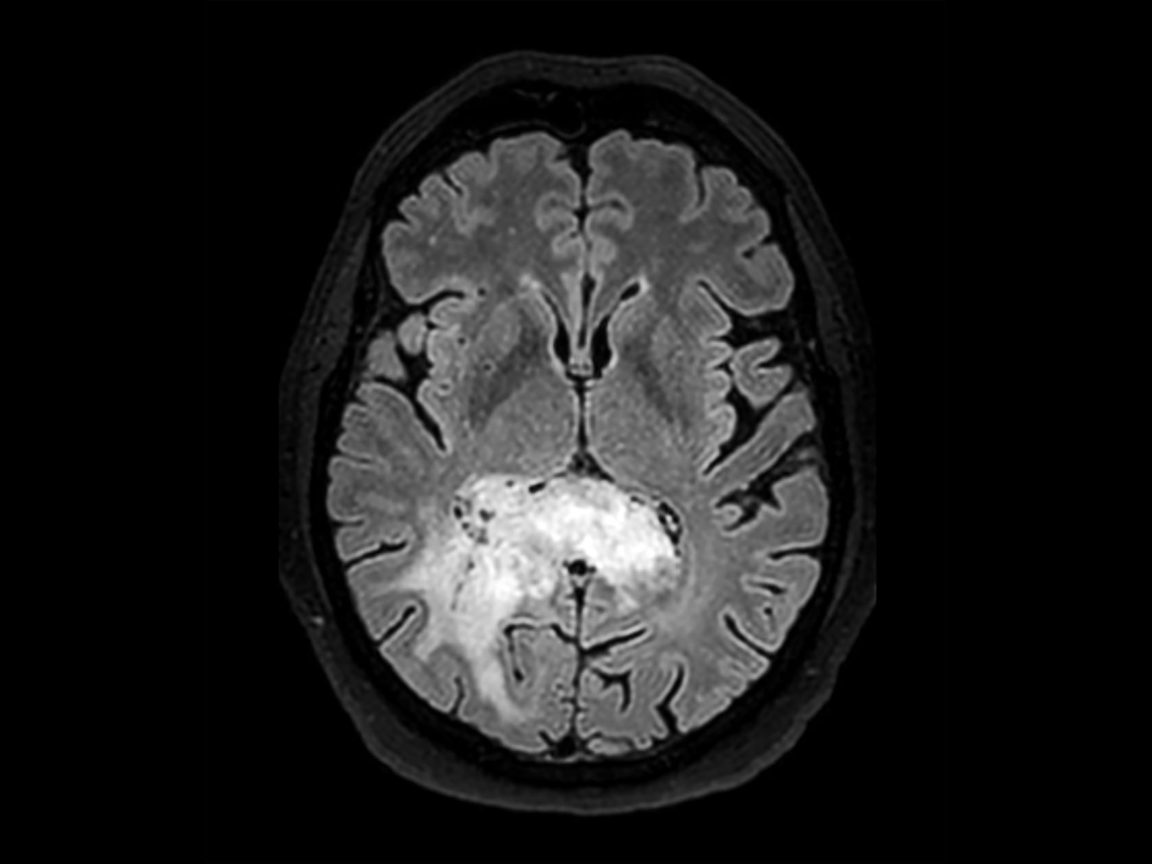 3D BrainVIEW FLAIR (axial reformat)