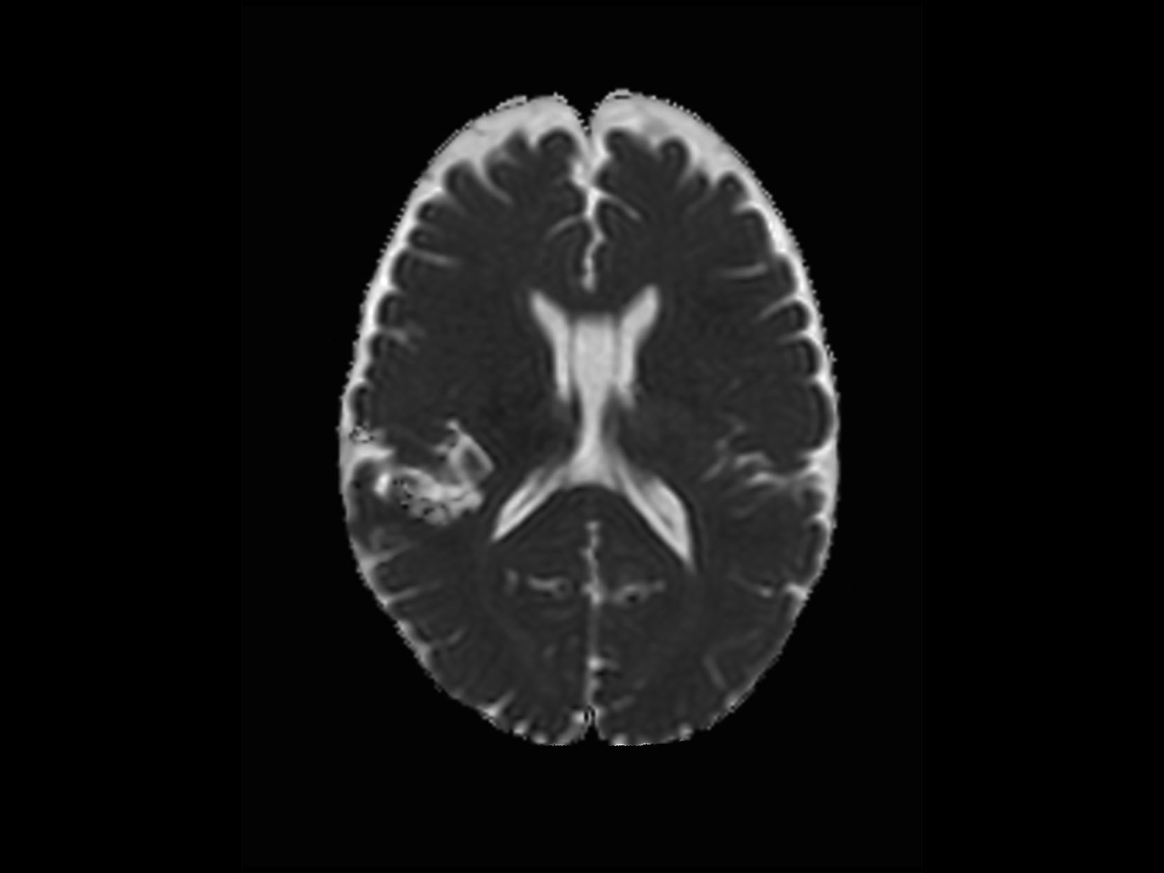 Axial DWI (ADC)