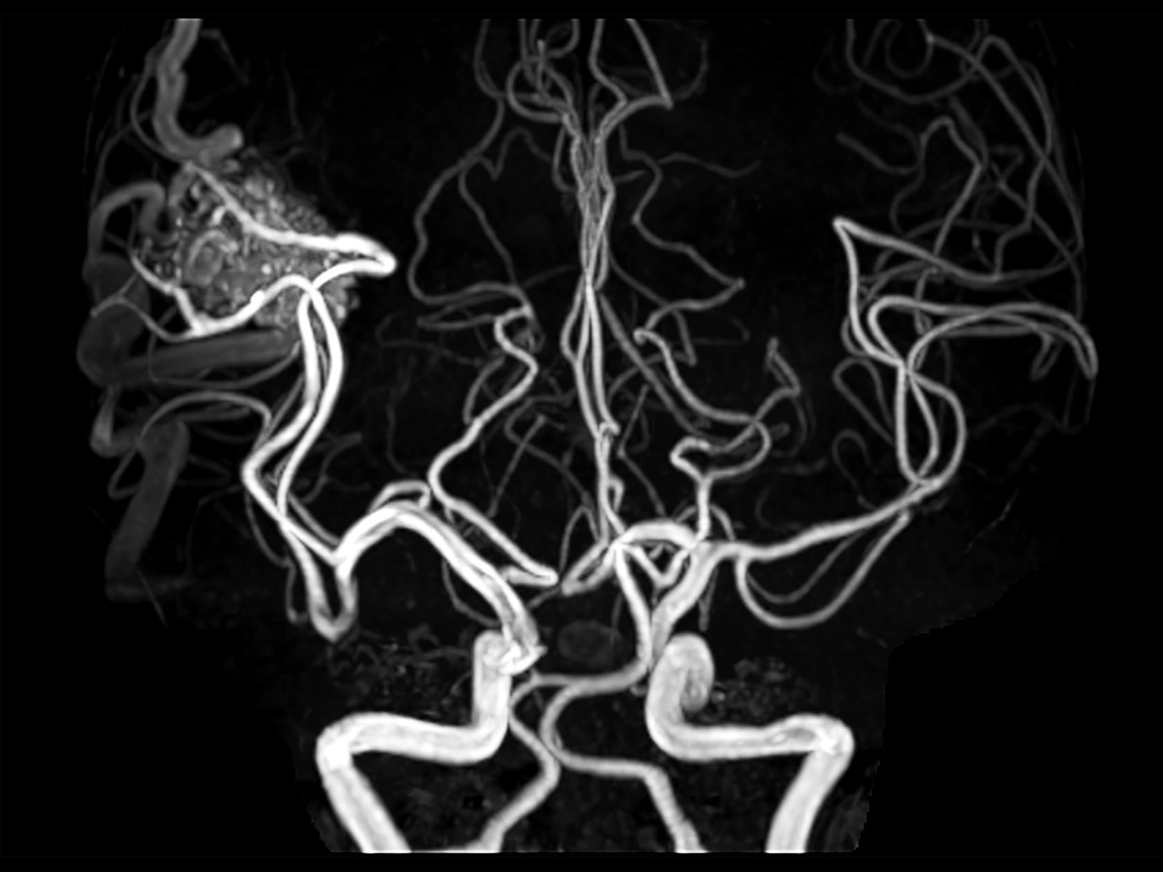 Coronal 3D Inflow