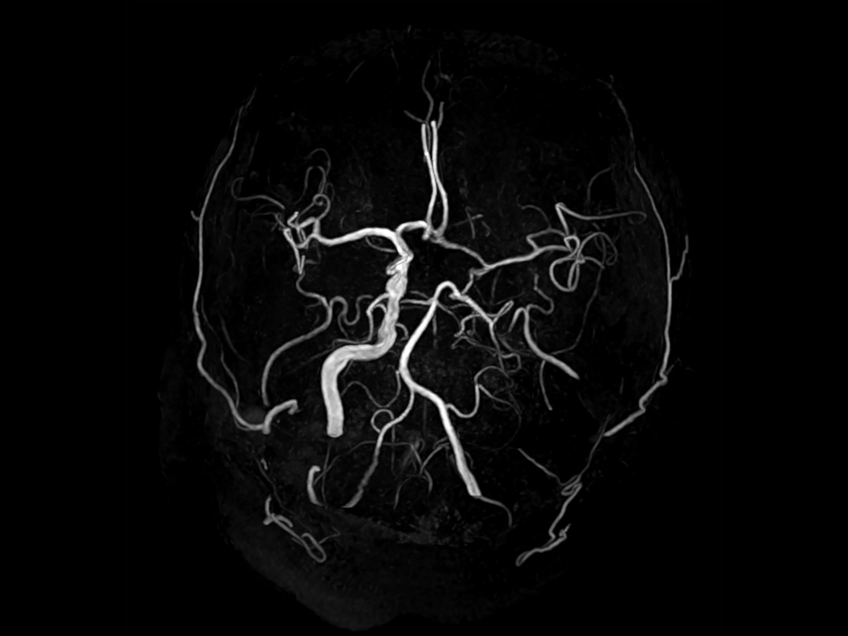 Axial 3D Inflow