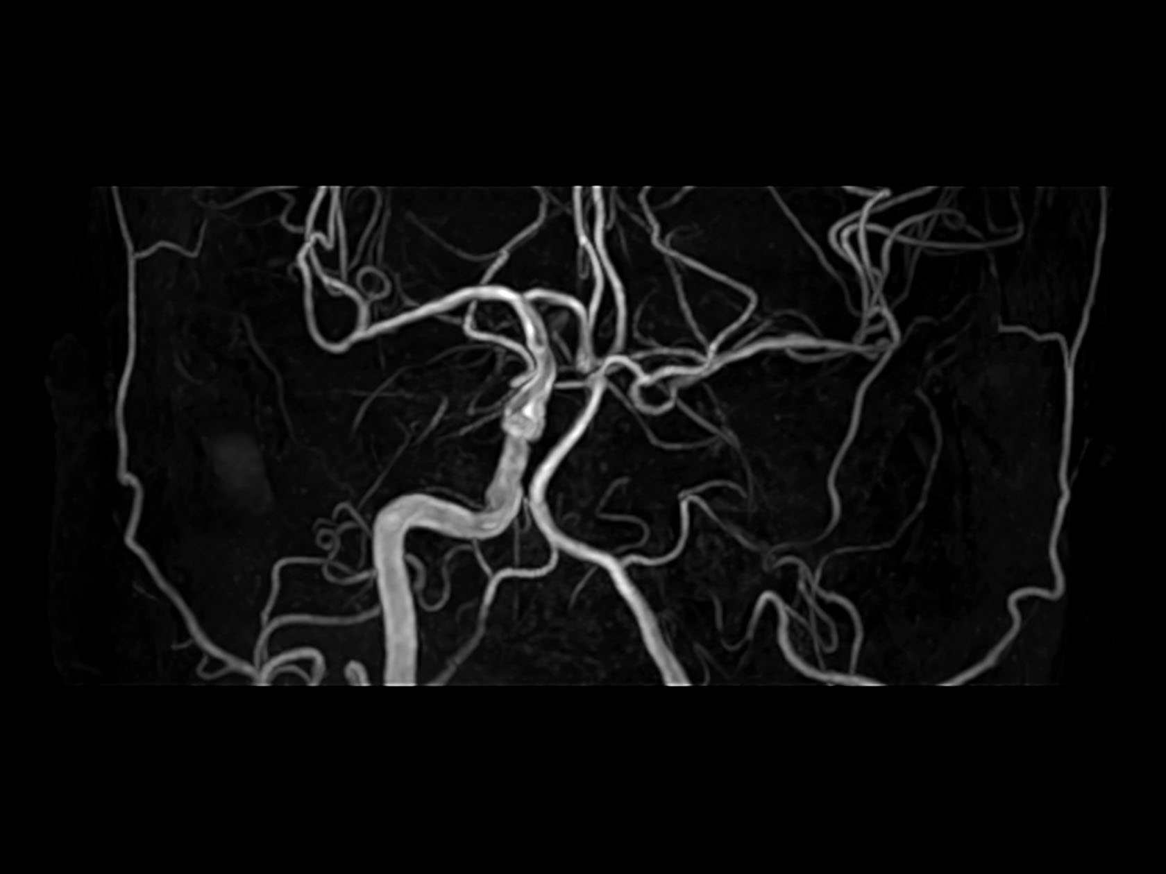 Coronal 3D Inflow