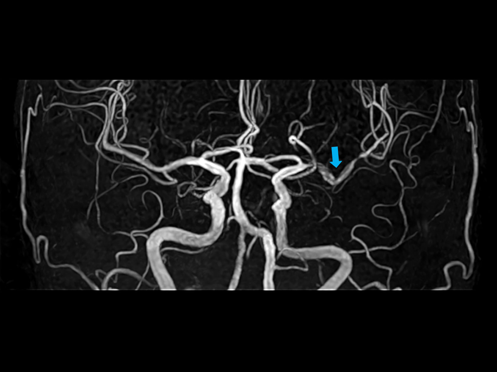 Coronal 3D Inflow