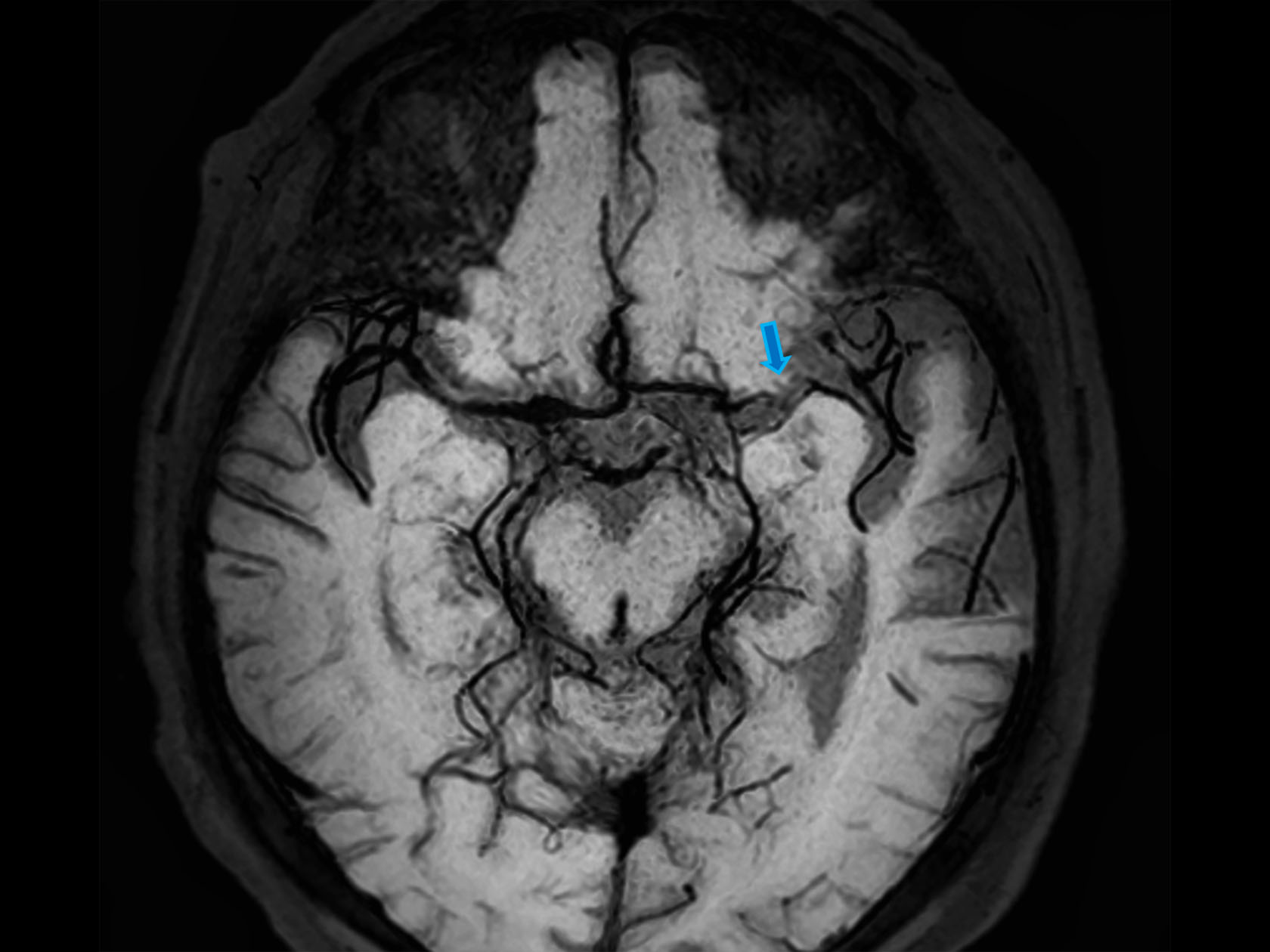 Axial 3D BrainVIEW Black Blood