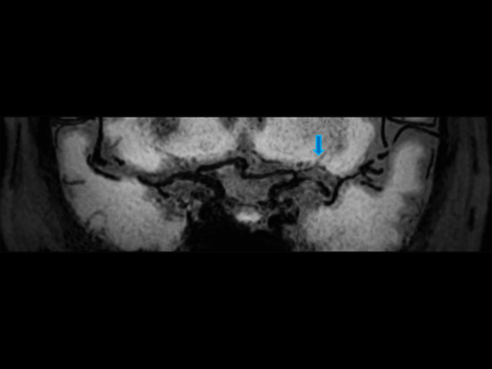 3D BrainVIEW Black Blood (coronal reformat)