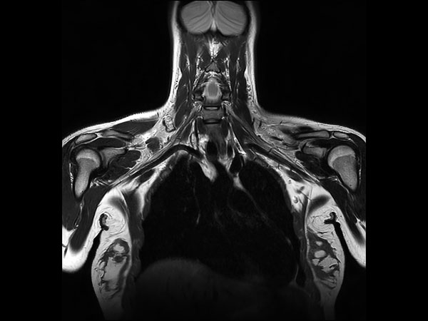 Coronal T2w TSE