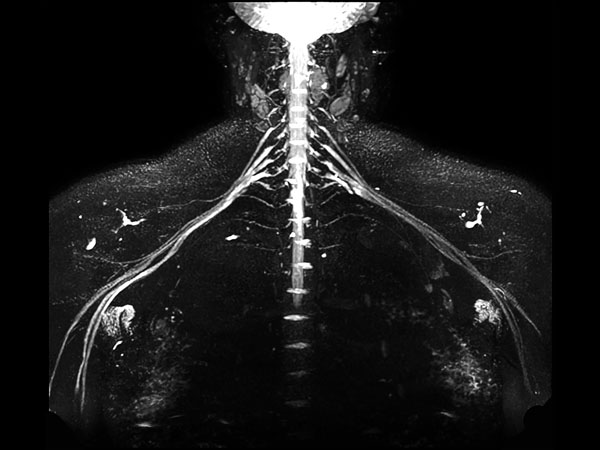 Coronal 3D NerveVIEW (MIP)