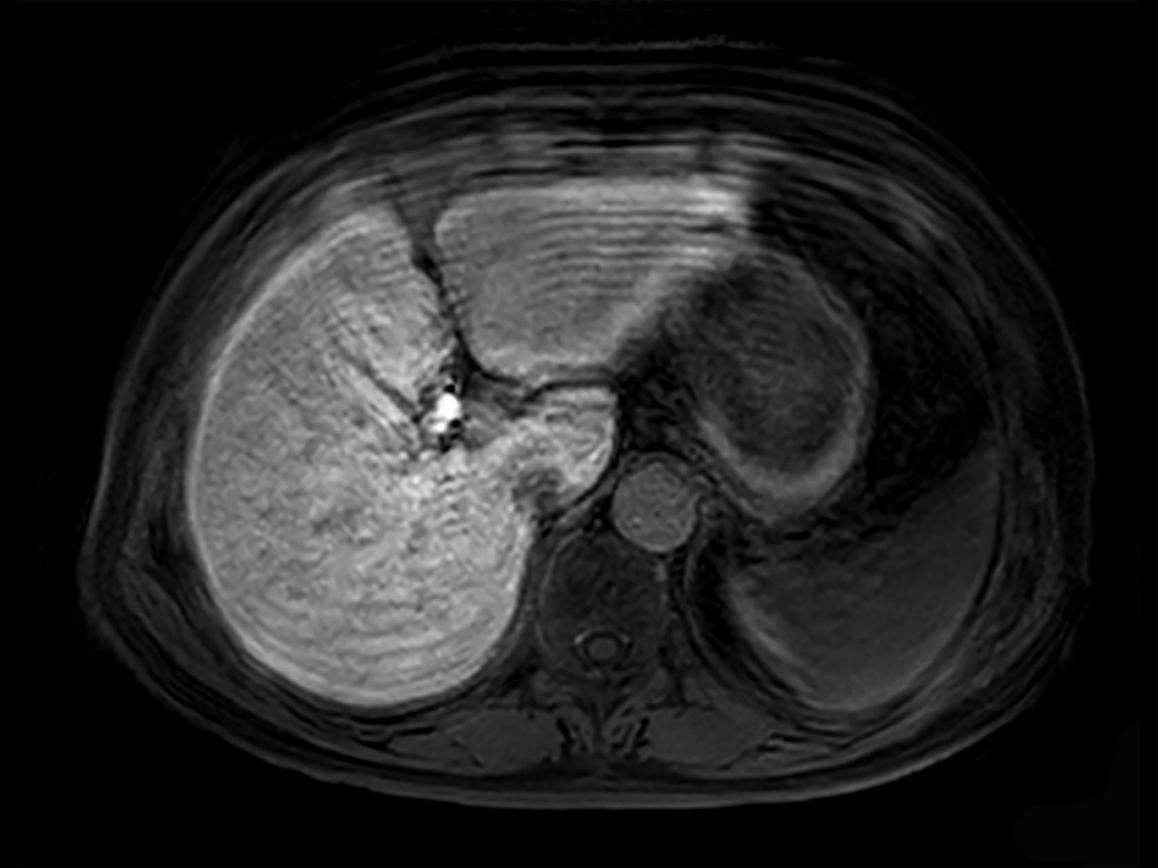 Axial eTHRIVE (failed breath hold)