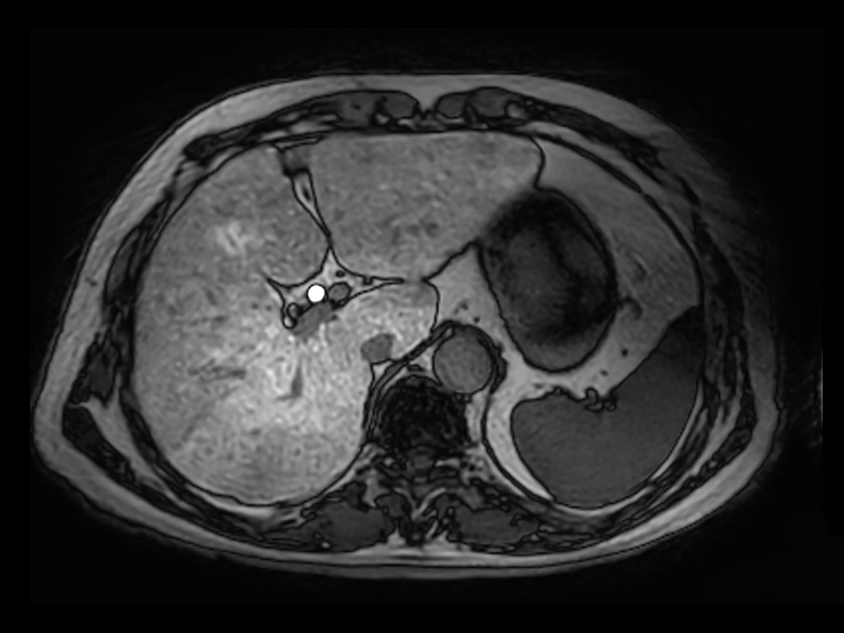 Axial 3D VANE XD (Out Phase)