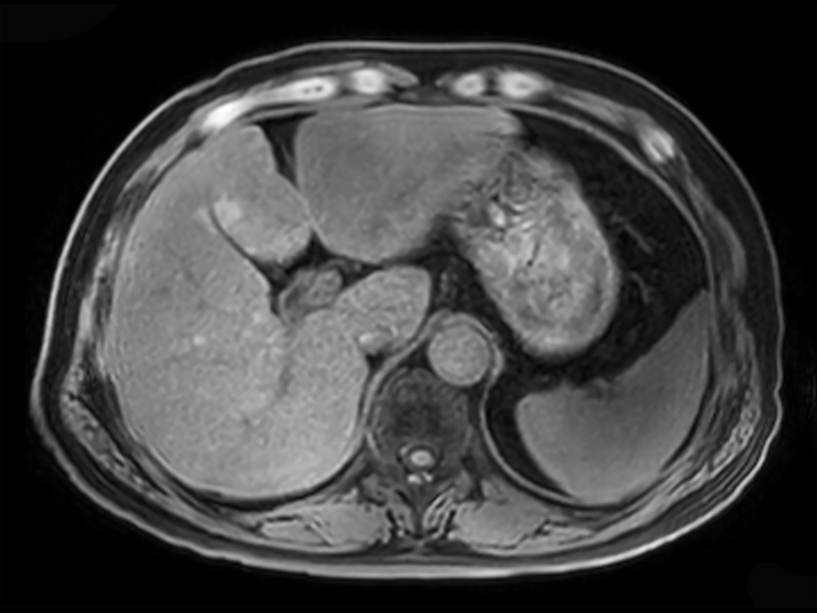 Axial mDIXON XD FFE (Water only)