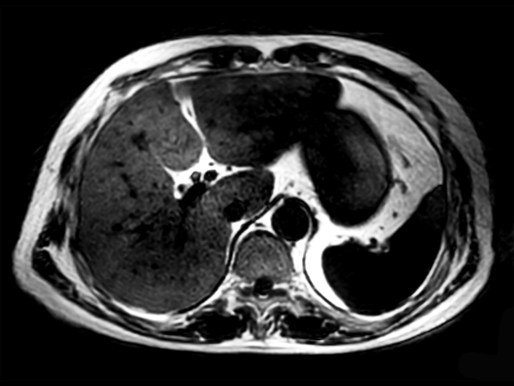 Axial 3D VANE XD (Fat only)