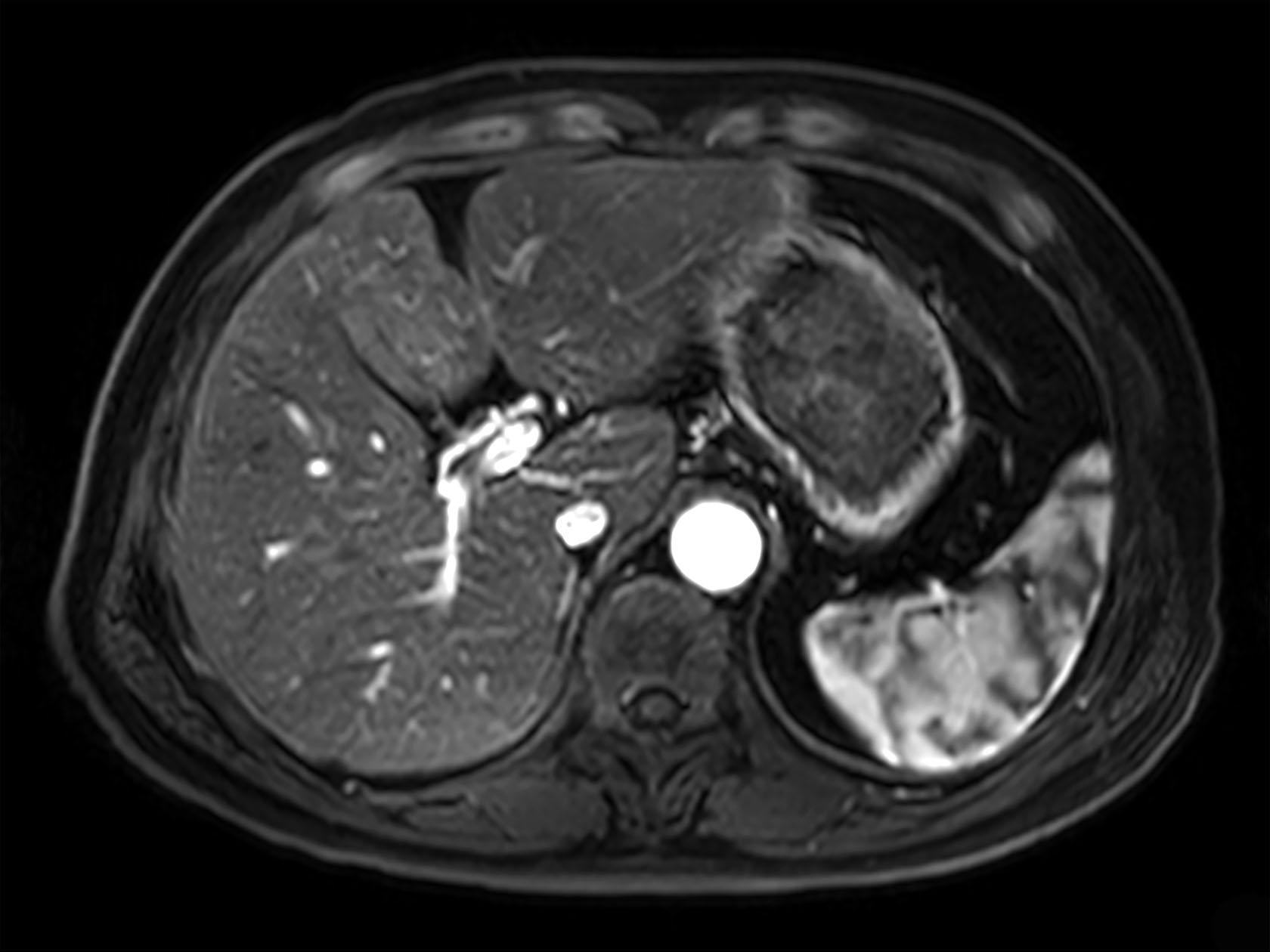 dyn mDIXON XD FFE  (post gado, arterial phase)
