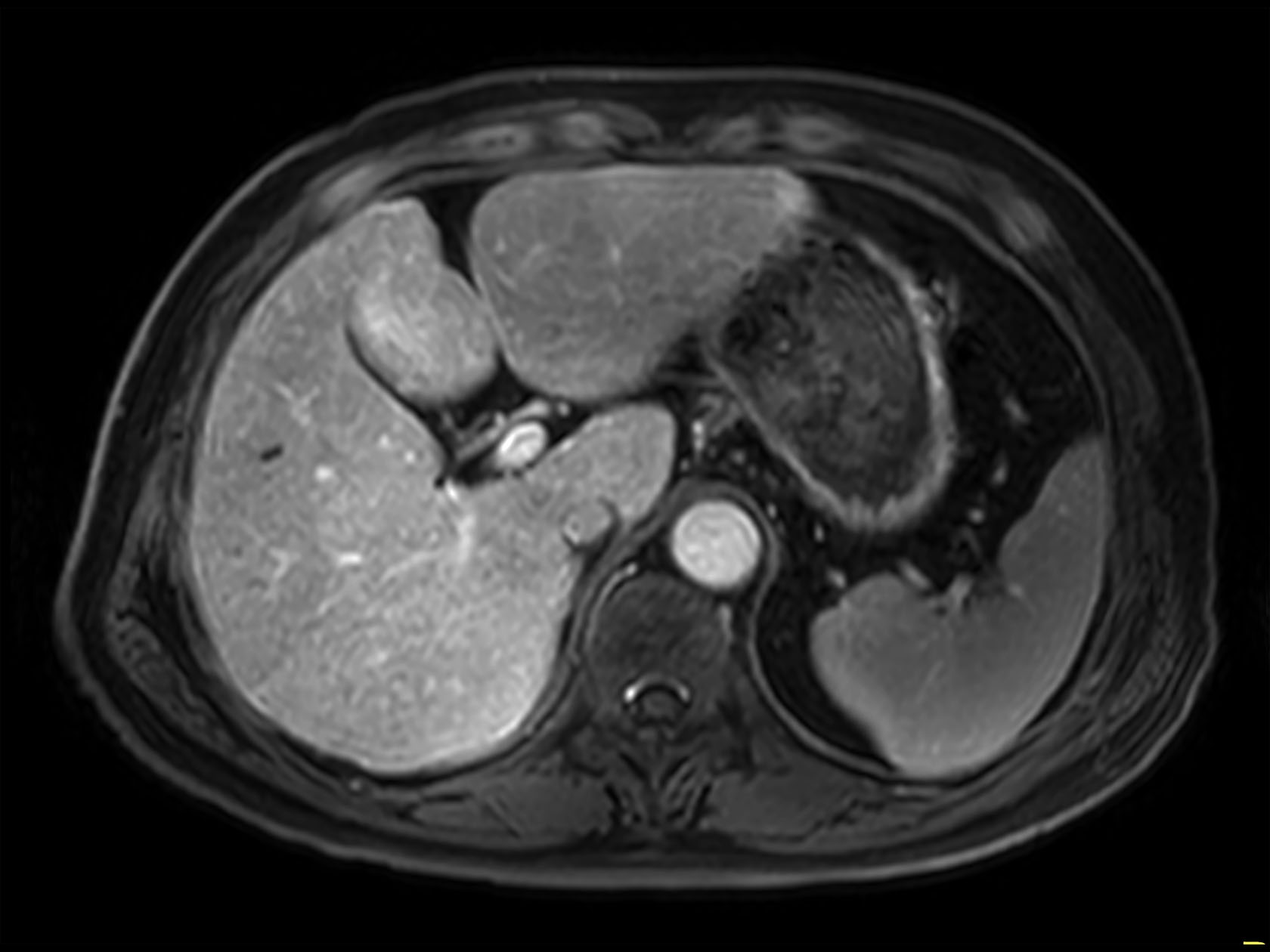 dyn mDIXON XD FFE  (post gado, venous phase)