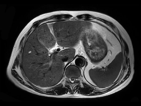 Axial T2w TSE (breath hold)