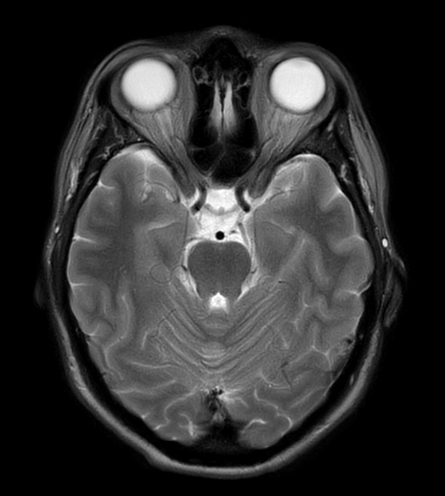 T2w TSE - MultiVane XD