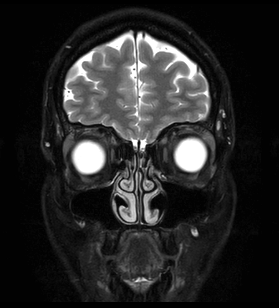 T2w TSE - mDIXON XD (Water only)