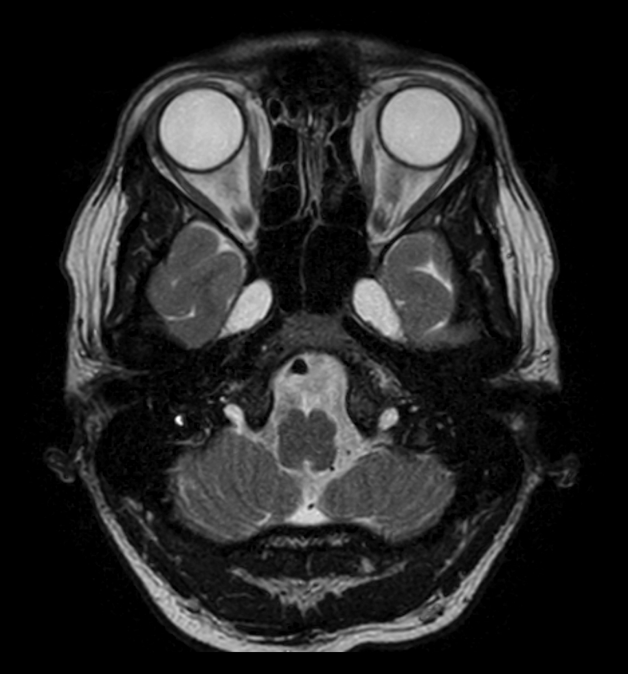 T2w TSE - mDIXON XD (In Phase)