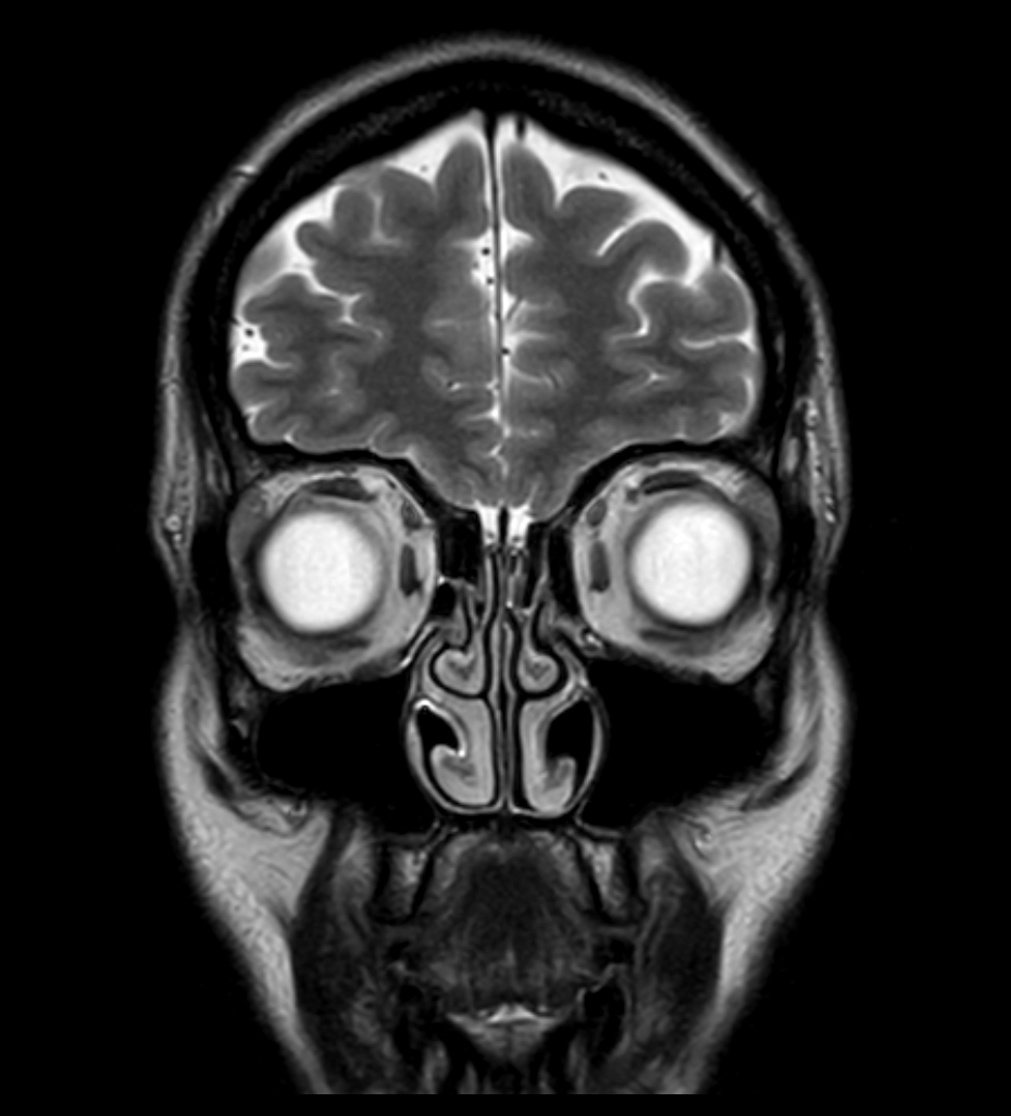 T2w TSE - mDIXON XD (In Phase)