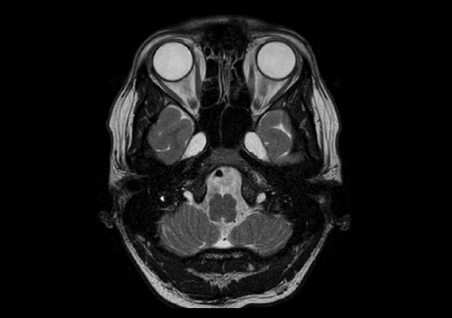 T2w TSE - mDIXON XD (In Phase)