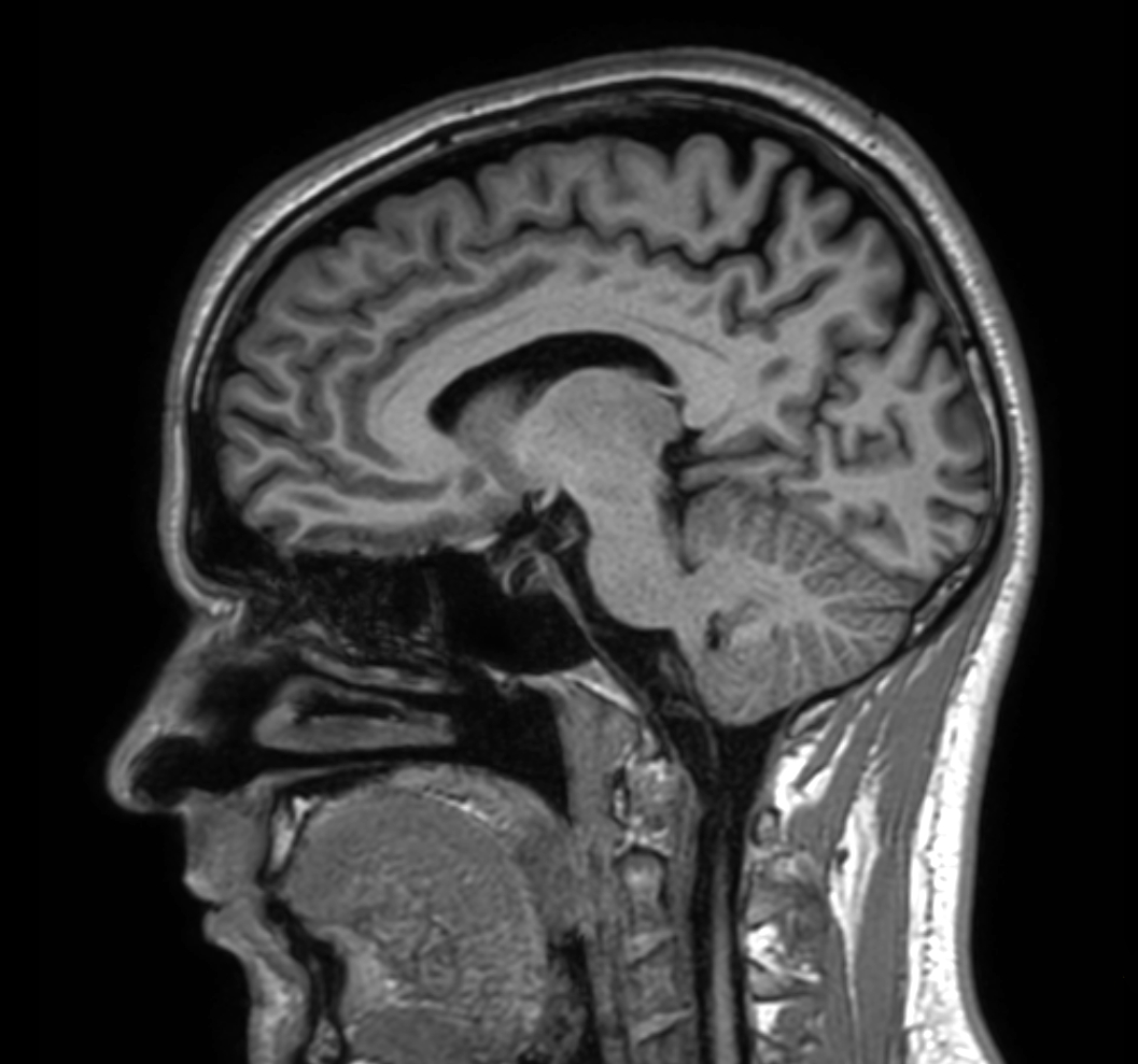 Sagittal 3D T1w TFE with ComforTone