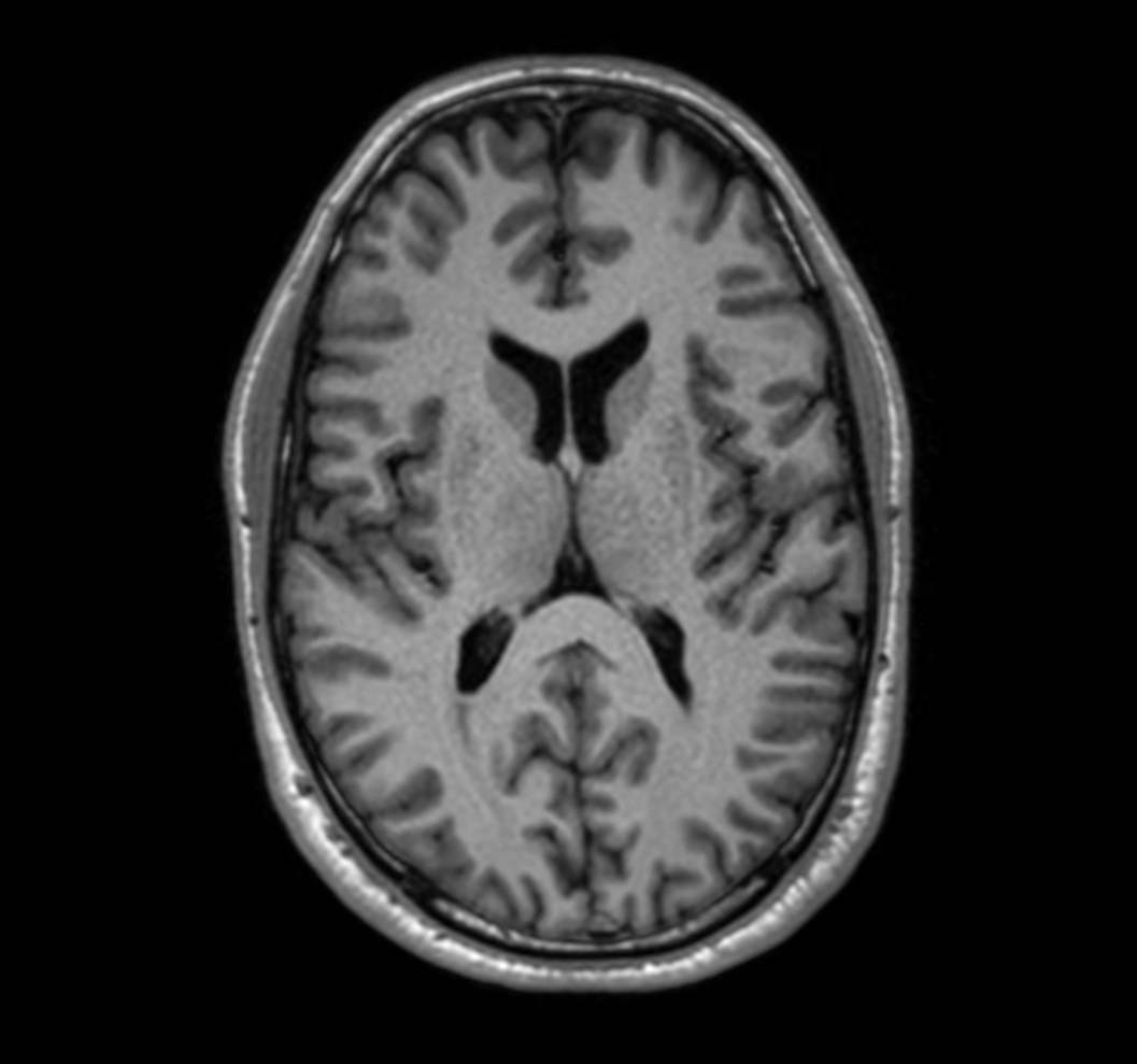 3D T1w TFE with ComforTone (axial reformat)