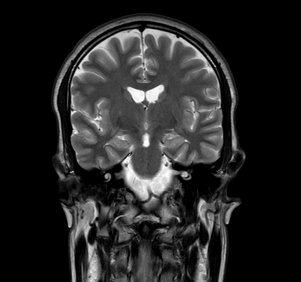 Coronal T2w TSE with ComforTone